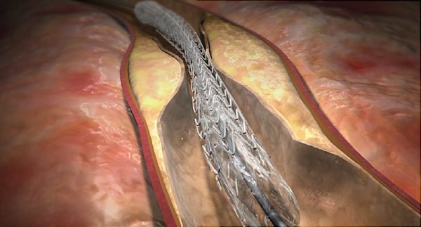 Angioplastia e stent